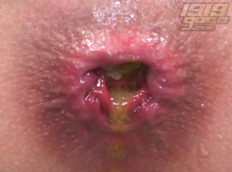 GoGo Japan Scatology Huge syringe in the anus. P1 [SD/2025]